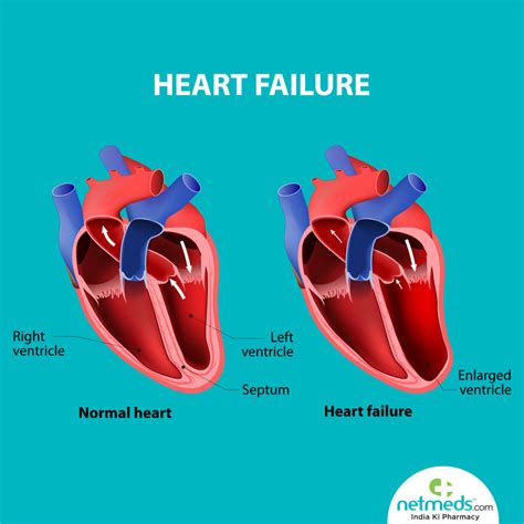 mild lv dysfunction treatment